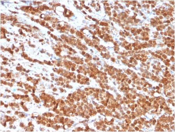 Formalin-fixed, paraffin-embedded human colon carcinoma stained with Interleukin-2 (IL-2) Mouse Monoclonal Antibody (IL2/3949). HIER: Tris/EDTA, pH9.0, 45min. 2°C: HRP-polymer, 30min. DAB, 5min.