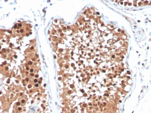 Formalin-fixed, paraffin-embedded human testicular carcinoma stained with Inhibin, alpha Mouse Monoclonal Antibody (R1).