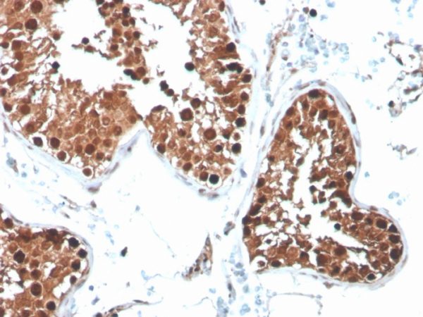 Formalin-fixed, paraffin-embedded human testicular carcinoma stained with Inhibin, alpha Mouse Monoclonal Antibody (R1).