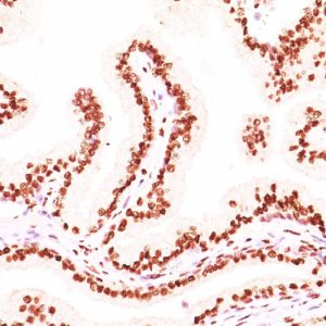 Formalin-fixed, paraffin-embedded human prostate carcinoma stained with Androgen Receptor Monoclonal Antibody (AR441 + DHTR/882).