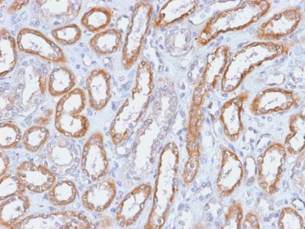 Formalin-fixed, paraffin-embedded human Renal Cell Carcinoma stained with CD61 Rabbit Recombinant Monoclonal Antibody (ITGB3/2166R).