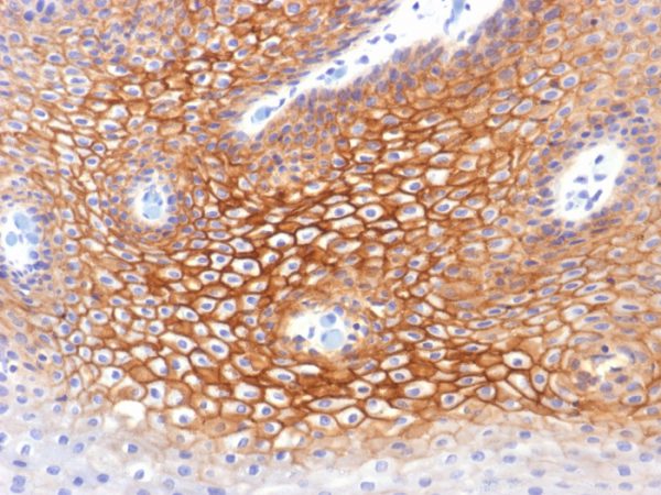 Formalin-fixed, paraffin-embedded human Cervical Carcinoma stained with Catenin, gamma Monoclonal Antibody (CTNG/1483)