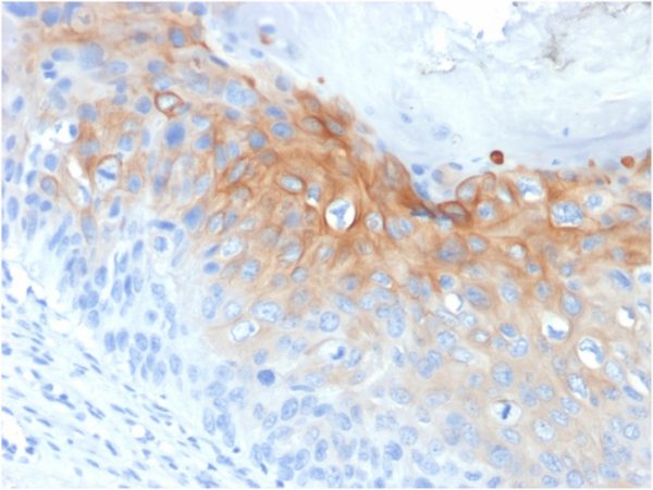 Formalin-fixed, paraffin-embedded human Cervical Carcinoma stained with  Cytokeratin 1 Mouse Monoclonal Antibody (KRT1/1840).