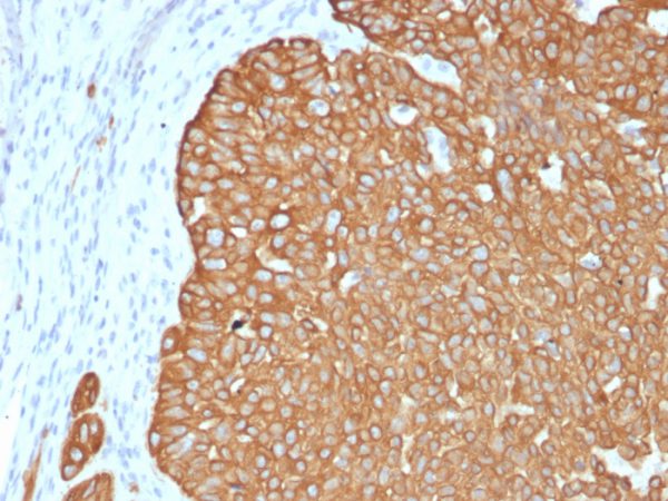 Formalin-fixed, paraffin-embedded human basal cell carcinoma stained with Cytokeratin 5 Recombinant Rabbit Monoclonal Antibody (KRT5/4245R).