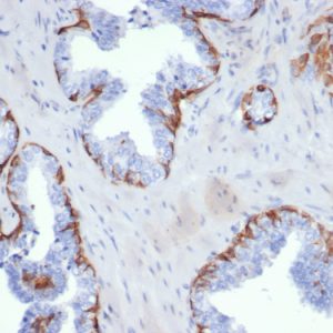 Formalin-fixed, paraffin-embedded human prostate carcinoma stained with Cytokeratin 5 Recombinant Rabbit Monoclonal Antibody (KRT5/6399R).