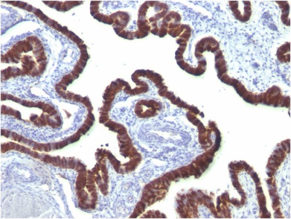 Formalin-fixed, paraffin-embedded human Ovarian Carcinoma stained with Cytokeratin 7 Mouse Monoclonal Antibody (OV-TL12/30)