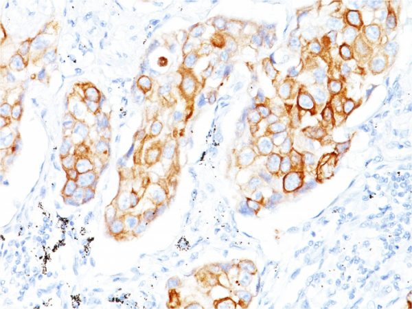 Formalin-fixed, paraffin-embedded human Lung SCC stained with Cytokeratin 7 Mouse Monoclonal Antibody (OV-TL12/30)