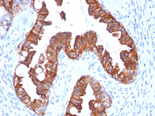 Formalin-fixed, paraffin-embedded human endometrial carcinoma stained with CK7 Recombinant Mouse Monoclonal Antibody (rOV-TL12/30).