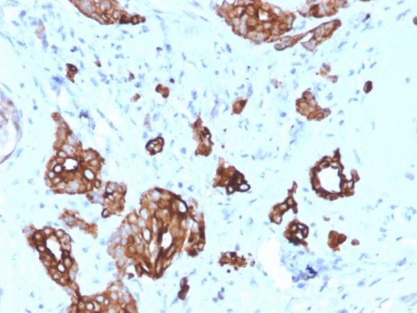 Formalin-fixed, paraffin-embedded human Breast Carcinoma stained with Cytokeratin-7 Mouse Monoclonal Antibody (KRT7/2200).