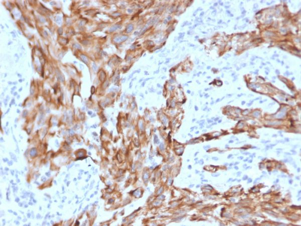 Formalin-fixed, paraffin-embedded human Lung Carcinoma stained with Cytokeratin-7 Mouse Monoclonal Antibody (KRT7/2200).