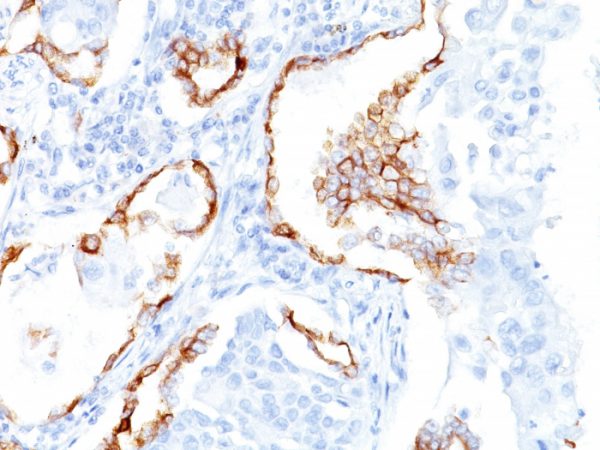 Formalin-fixed, paraffin-embedded human Lung SCC stained with Cytokeratin 7 Mouse Monoclonal Antibody (K72.7).