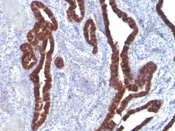 Formalin-fixed, paraffin-embedded Ovarian Carcinoma stained with Cytokeratin 7 Mouse Monoclonal Antibody (K72.7).