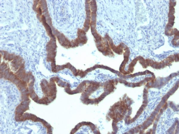 Formalin-fixed, paraffin-embedded human Ovarian Carcinoma stained with Cytokeratin 7 Mouse Monoclonal Antibody (KRT7/903)