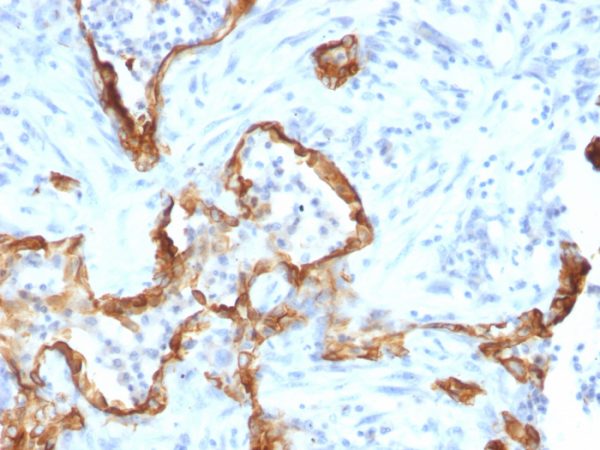 Formalin-fixed, paraffin-embedded human Lung Carcinoma stained with Cytokeratin 8 Monoclonal Antibody (SPM192).