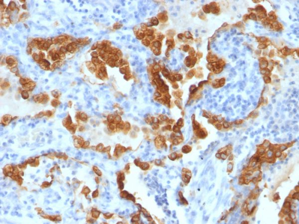 Formalin-fixed, paraffin-embedded human Lung Carcinoma stained with Cytokeratin 8 Mouse Monoclonal Antibody (H1+TS1)