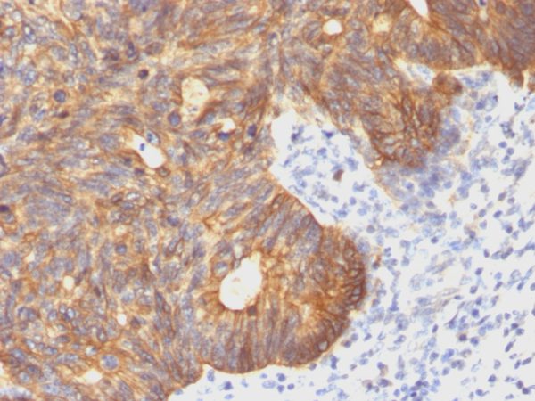 Formalin-fixed, paraffin-embedded human Colon Carcinoma stained with Cytokeratin 8 Mouse Monoclonal Antibody (C-43).