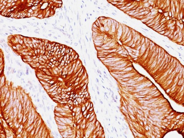 Formalin-fixed, paraffin-embedded human Colon Carcinoma stained with Cytokeratin 8 Mouse Monoclonal Antibody (K8.8).