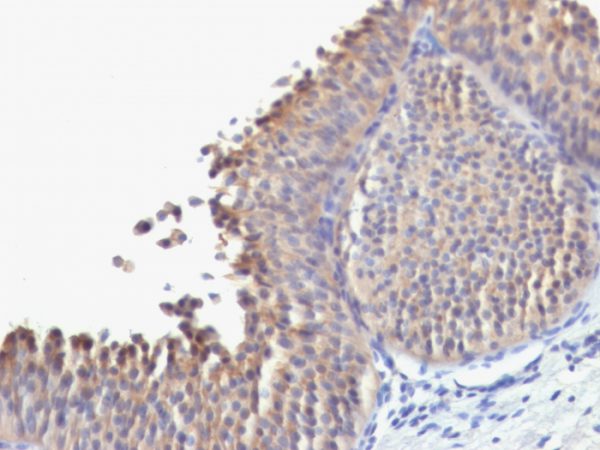 Formalin-fixed, paraffin-embedded human Bladder Carcinoma stained with Cytokeratin 10 Monoclonal Antibody (SPM623).