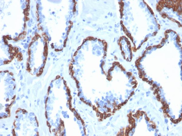 Formalin-fixed, paraffin-embedded human Prostate Carcinoma stained with Cytokeratin 13 Mouse Monoclonal Antibody (KRT13/2659).