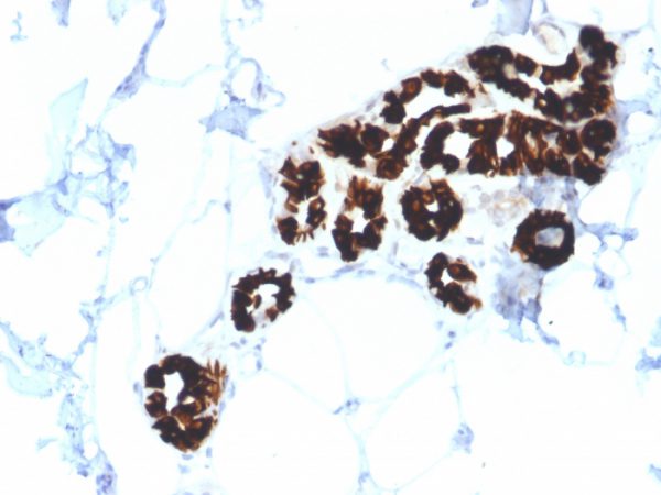 Formalin-fixed, paraffin-embedded human Basal Cell Carcinoma stained with Cytokeratin 15 Mouse Monoclonal Antibody (KRT15/2554).