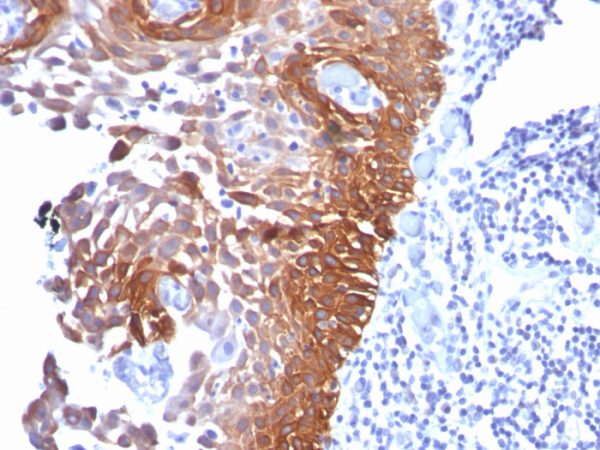 Formalin-fixed, paraffin-embedded human Cervical Carcinoma stained with CK17 Mouse Monoclonal Antibody (E3).