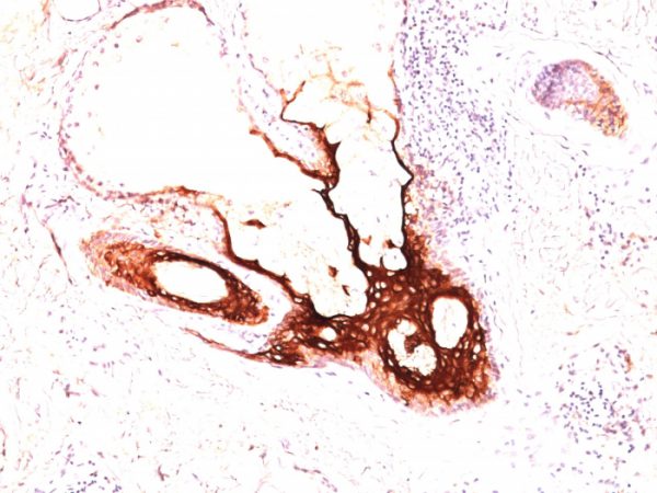 Formalin-fixed, paraffin-embedded human skin stained with CK17 Monoclonal Antibody (SPM560).