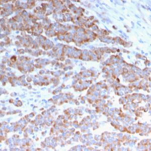 Formalin-fixed, paraffin-embedded human Colon Carcinoma stained with Cytokeratin 18 Mouse Monoclonal Antibody (rKRT18/1190).
