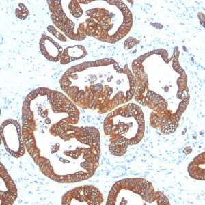 Formalin-fixed, paraffin-embedded human Colon Carcinoma stained with Cytokeratin 18 Mouse Monoclonal Antibody (DE-K18).