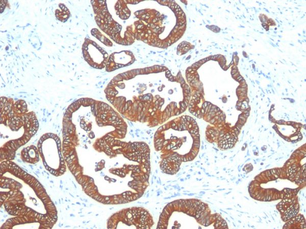 Formalin-fixed, paraffin-embedded human Colon Carcinoma stained with Cytokeratin 18 Mouse Monoclonal Antibody (DE-K18).