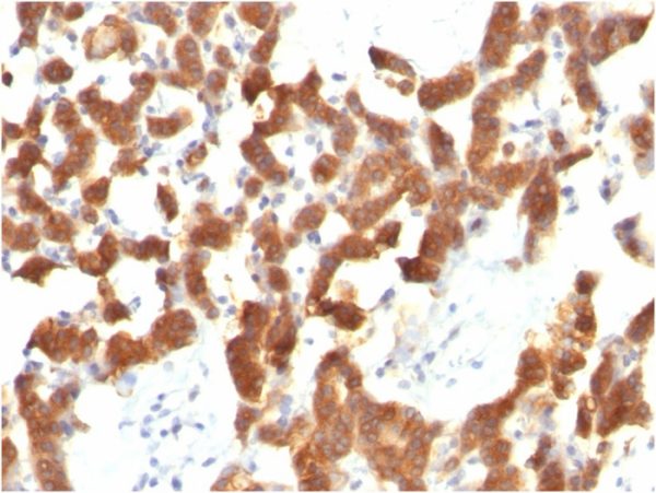 Formalin-fixed, paraffin-embedded human Thyroid Carcinoma stained with Cytokeratin 18 Mouse Monoclonal Antibody (KRT18/834).