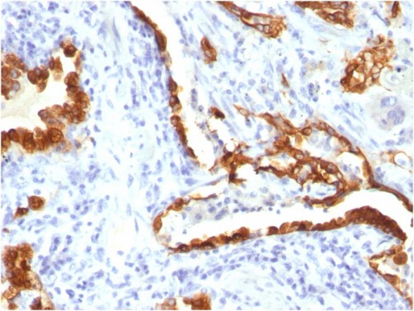 Formalin-fixed, paraffin-embedded human Lung Carcinoma stained with Cytokeratin 18 Mouse Monoclonal Antibody (KRT18/834).