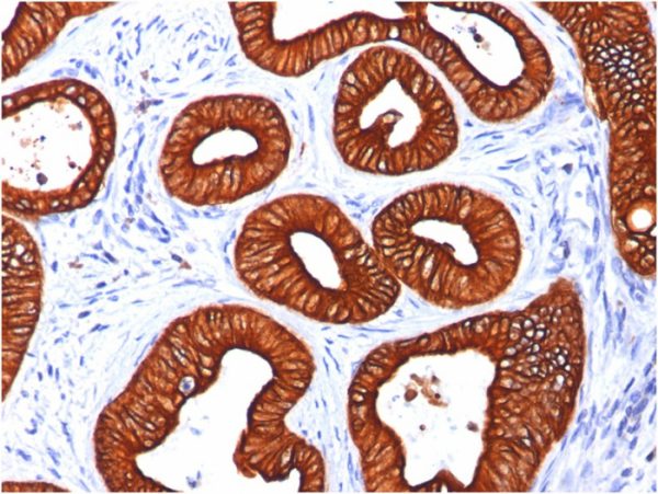 Formalin-fixed, paraffin-embedded human Colon Carcinoma stained with Cytokeratin 18 Mouse Monoclonal Antibody (KRT18/834).