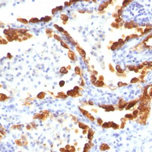 Formalin-fixed, paraffin-embedded human Lung Cancer stained with Cytokeratin 18 Mouse Monoclonal Antibody (KRT18/835).