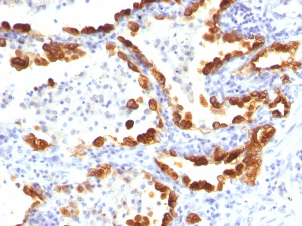 Formalin-fixed, paraffin-embedded human Lung Cancer stained with Cytokeratin 18 Mouse Monoclonal Antibody (KRT18/835).