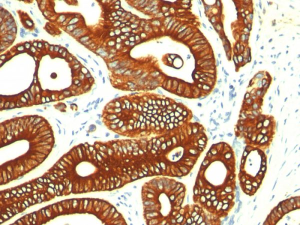 Formalin-fixed, paraffin-embedded human Colon Carcinoma stained with Cytokeratin 18 Mouse Monoclonal Antibody (KRT18/835).