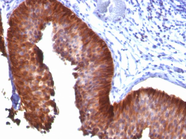 Formalin-fixed, paraffin-embedded human Bladder Carcinoma stained with Cytokeratin 18 Mouse Monoclonal Antibody (KRT18/835).