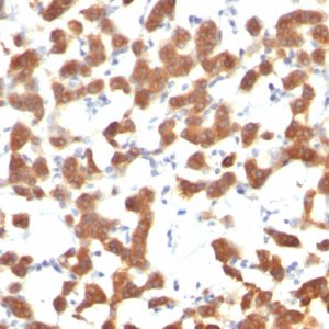 Formalin-fixed, paraffin-embedded human Thyroid Carcinoma stained with Cytokeratin 18 Mouse Monoclonal Antibody (C-04).