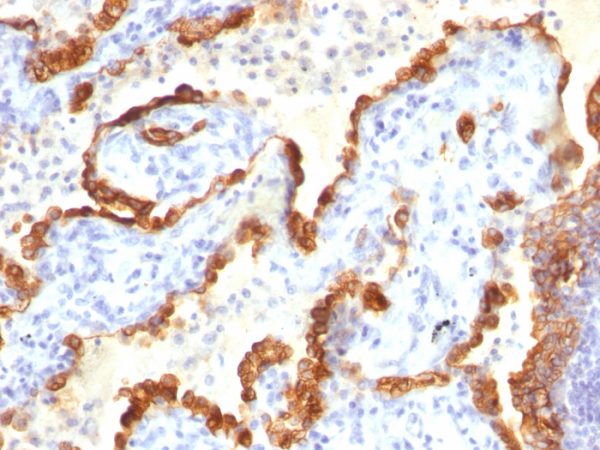 Formalin-fixed, paraffin-embedded human Lung Ca stained with Cytokeratin 18 Mouse Monoclonal Antibody (Cocktail).