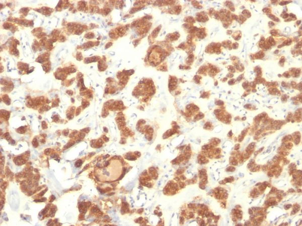 Formalin-fixed, paraffin-embedded human Thyroid Ca stained with Cytokeratin 18 Mouse Monoclonal Antibody (Cocktail).