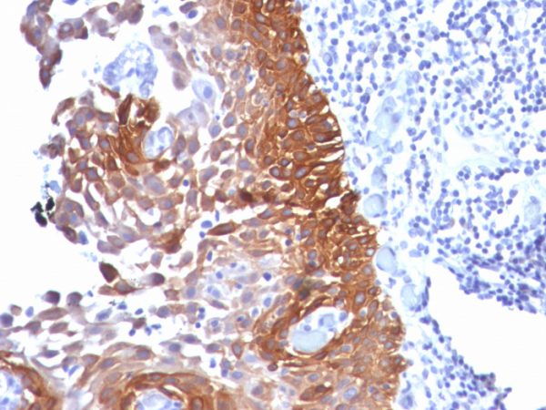 Formalin-fixed, paraffin-embedded human Cervical Ca stained with Cytokeratin 18 Mouse Monoclonal Antibody (Cocktail).