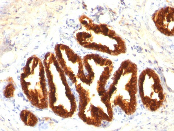 Formalin-fixed, paraffin-embedded human Prostate Carcinoma stained with Cytokeratin 18 Mouse Monoclonal Antibody (Cocktail).