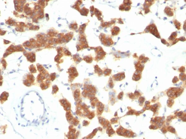 Formalin-fixed, paraffin-embedded Thyroid Carcinoma stained with Cytokeratin 18 Monoclonal Antibody (B23.1).