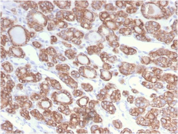 Formalin-fixed, paraffin-embedded human Thyroid Carcinoma stained with CK18 Rabbit Recombinant Monoclonal Antibody (KRT18/2808R).