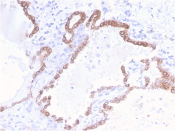 Formalin-fixed, paraffin-embedded human Colon Carcinoma stained with CK18 Rabbit Recombinant Monoclonal Antibody (KRT18/2808R).