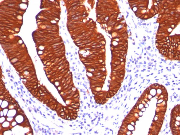 Formalin-fixed, paraffin-embedded colon carcinoma stained with Cytokeratin 19 Mouse Monoclonal Antibody (A53-B/A2.26).