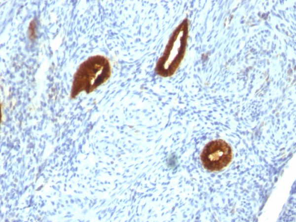 Formalin-fixed, paraffin-embedded human Endometrial Carcinoma stained with Cytokeratin 19 Mouse Monoclonal Antibody (SPM266).