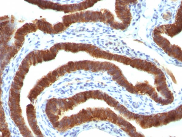 Formalin-fixed, paraffin-embedded human Ovarian Carcinoma stained with Cytokeratin 19 Ab (Ks19.1)