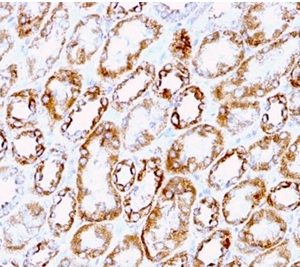 Formalin-fixed, paraffin-embedded human renal cell carcinoma stained with Laminin Rat Monoclonal Antibody (A5).