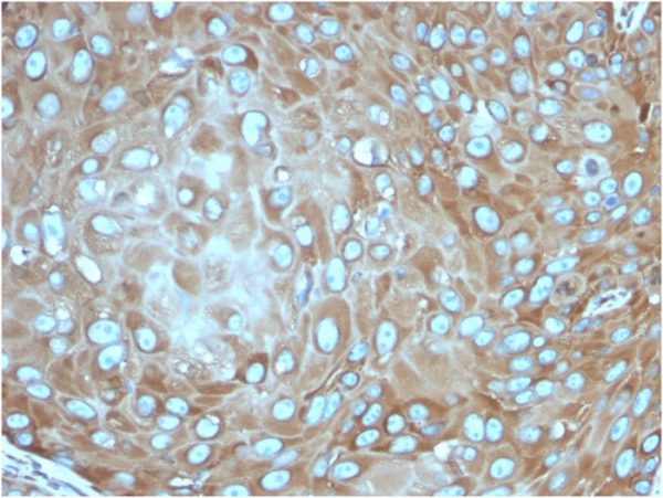 Formalin-fixed, paraffin-embedded human skin squamous cell carcinomastained with Laminin Receptor Recombinant Mouse Monoclonal Antibody (rRPSA/6333).