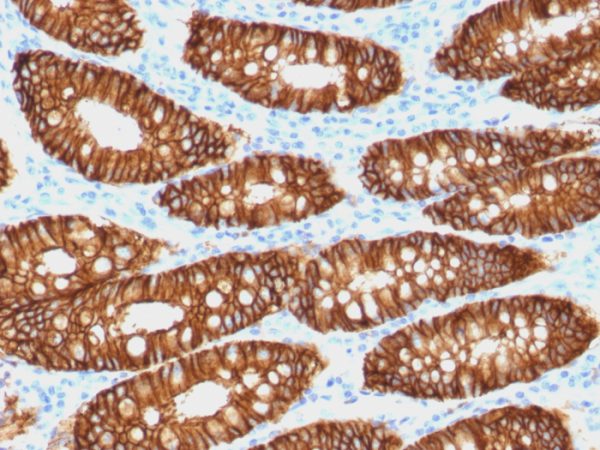 Formalin-fixed, paraffin-embedded human colon carcinoma stained with Biotin-conjugated Ep-CAM Mouse Monoclonal Antibody (VU-1D9).